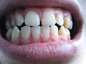 出现牙龈萎缩怎么办?